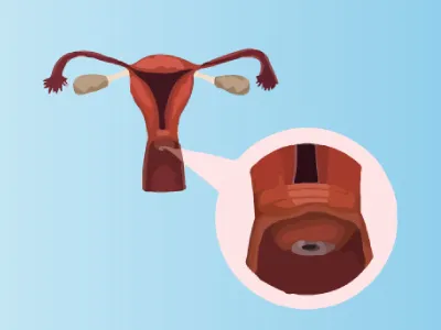 Cervical-dysplasia