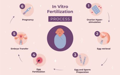 IVF Protocol for PCOS Patients