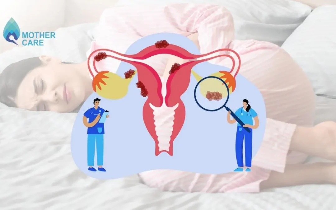 Endometrioma vs Endometriosis