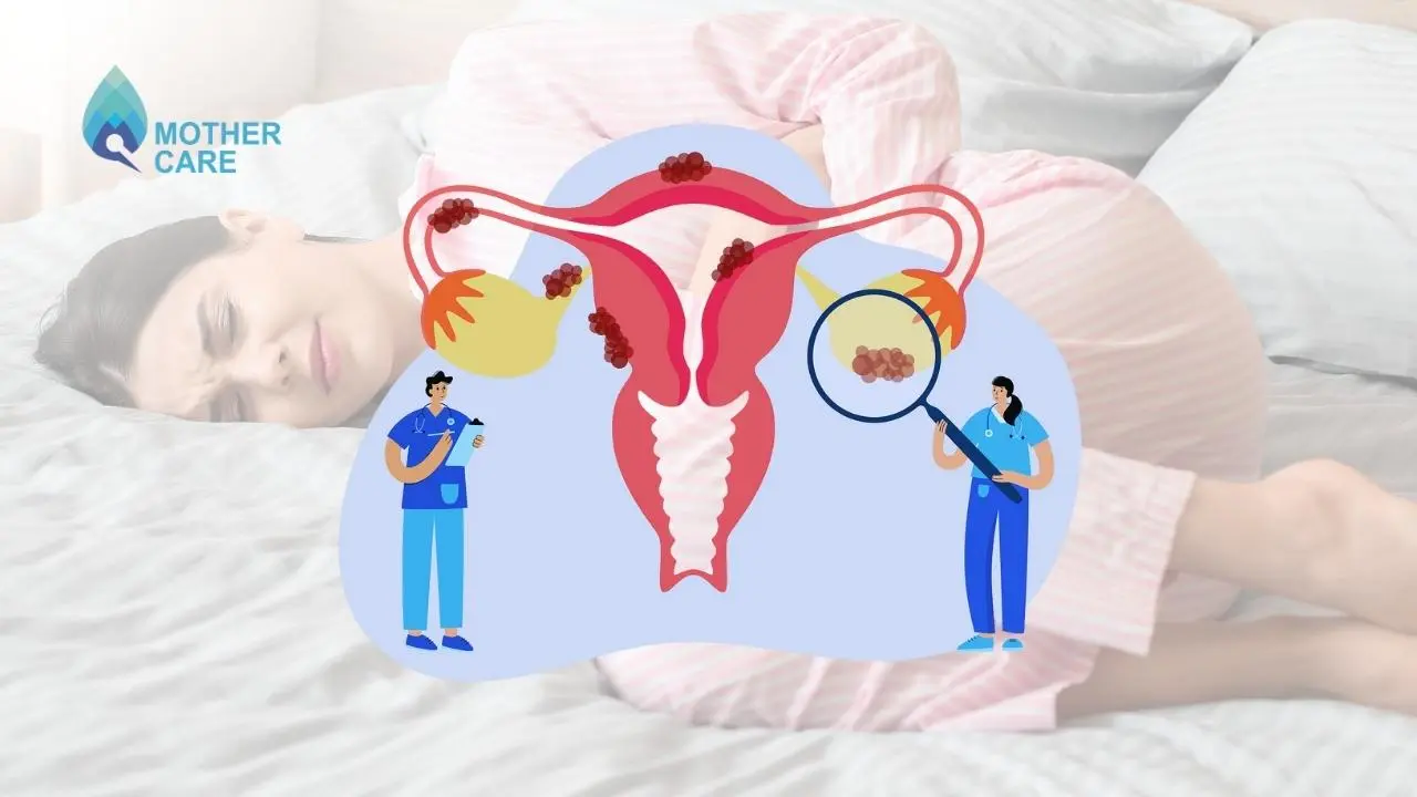 Endometrioma vs Endometriosis