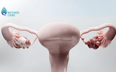 How to Shrink Ovarian Cysts Naturally?